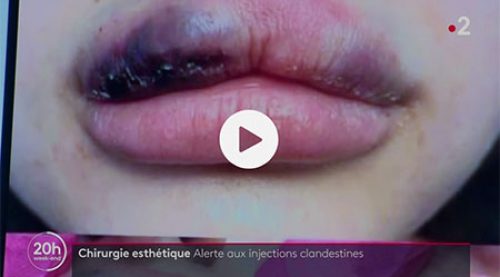 Alerte sur les injections d'cide hyaluronique à Hyères - Dr Plault